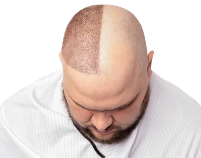 Hair Transplant
