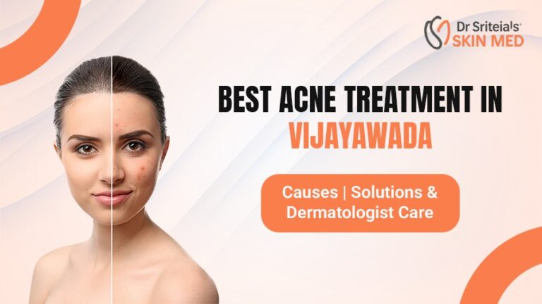 Best acne treatment in Vijayawada by dermatologist showing before and after acne results